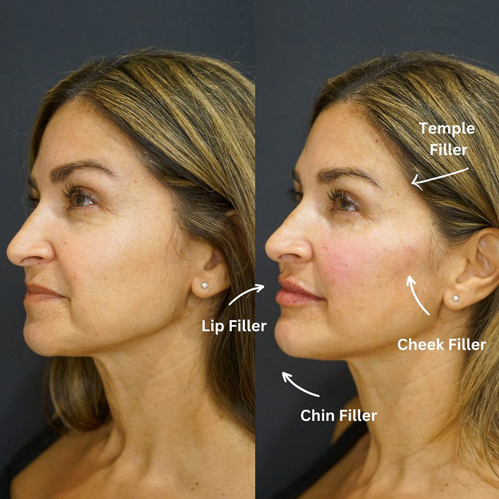 Juvéderm dermal fillers