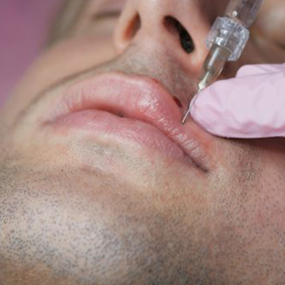 lip filler men