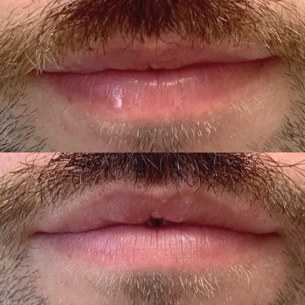 lip filler men