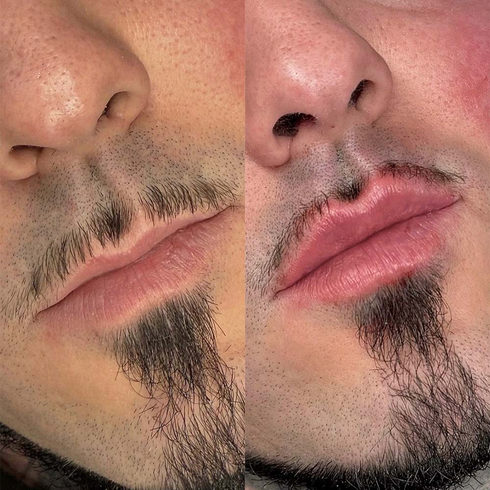 lip filler men