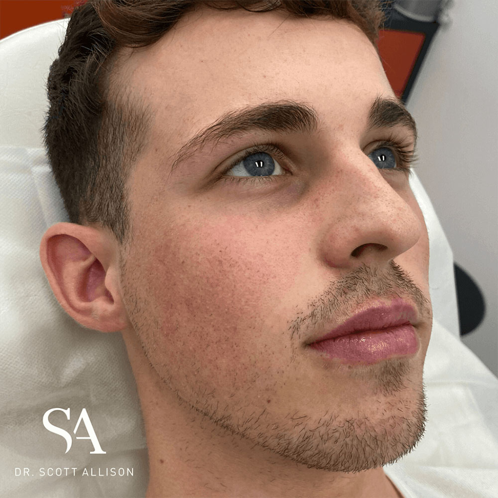 lip filler men