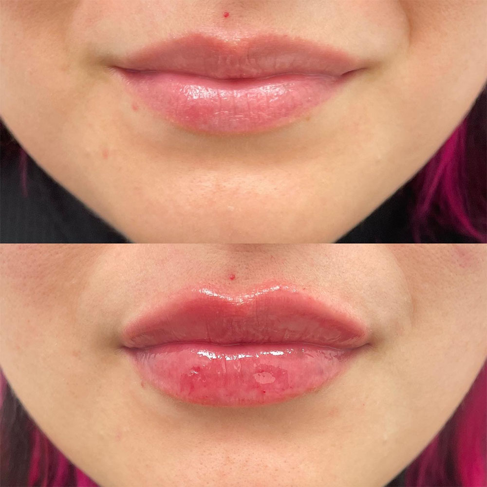 juvederm lip filler