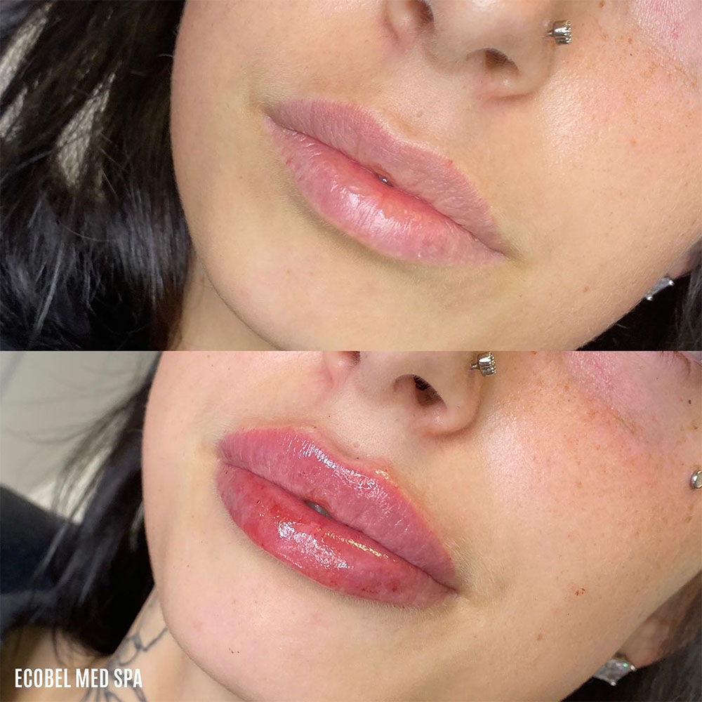 juvederm lip filler