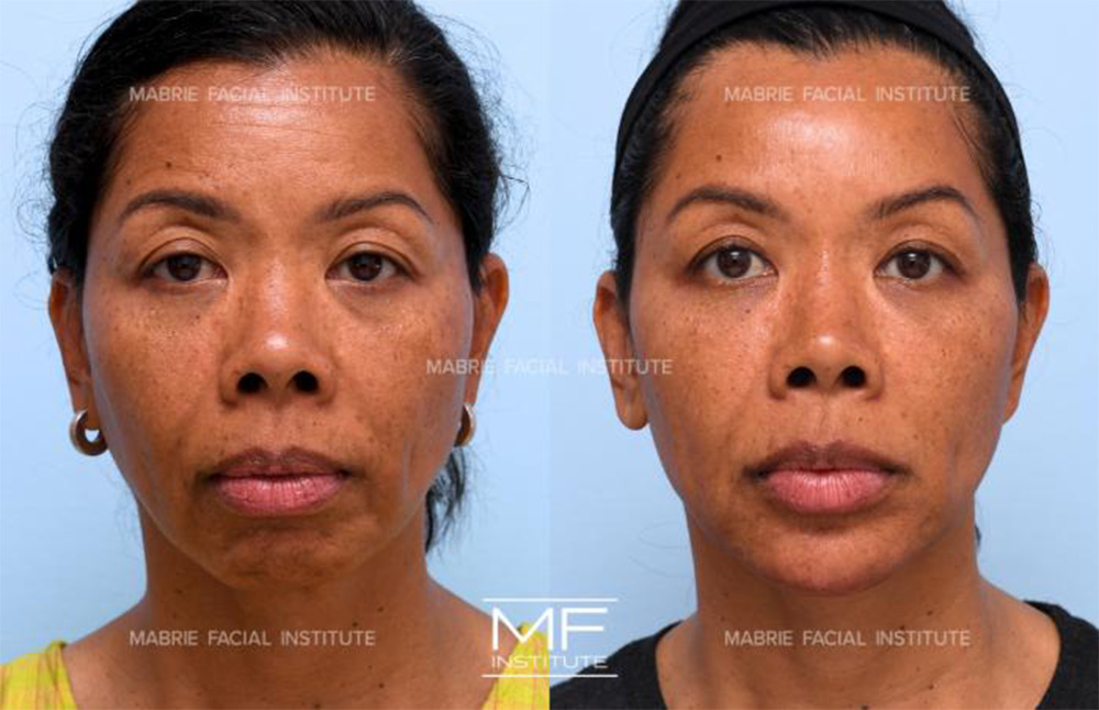 how long does juvederm last