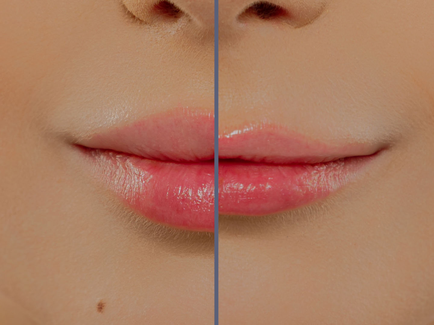 Juvéderm Before and After: Clinical Insights and Treatment Outcomes
