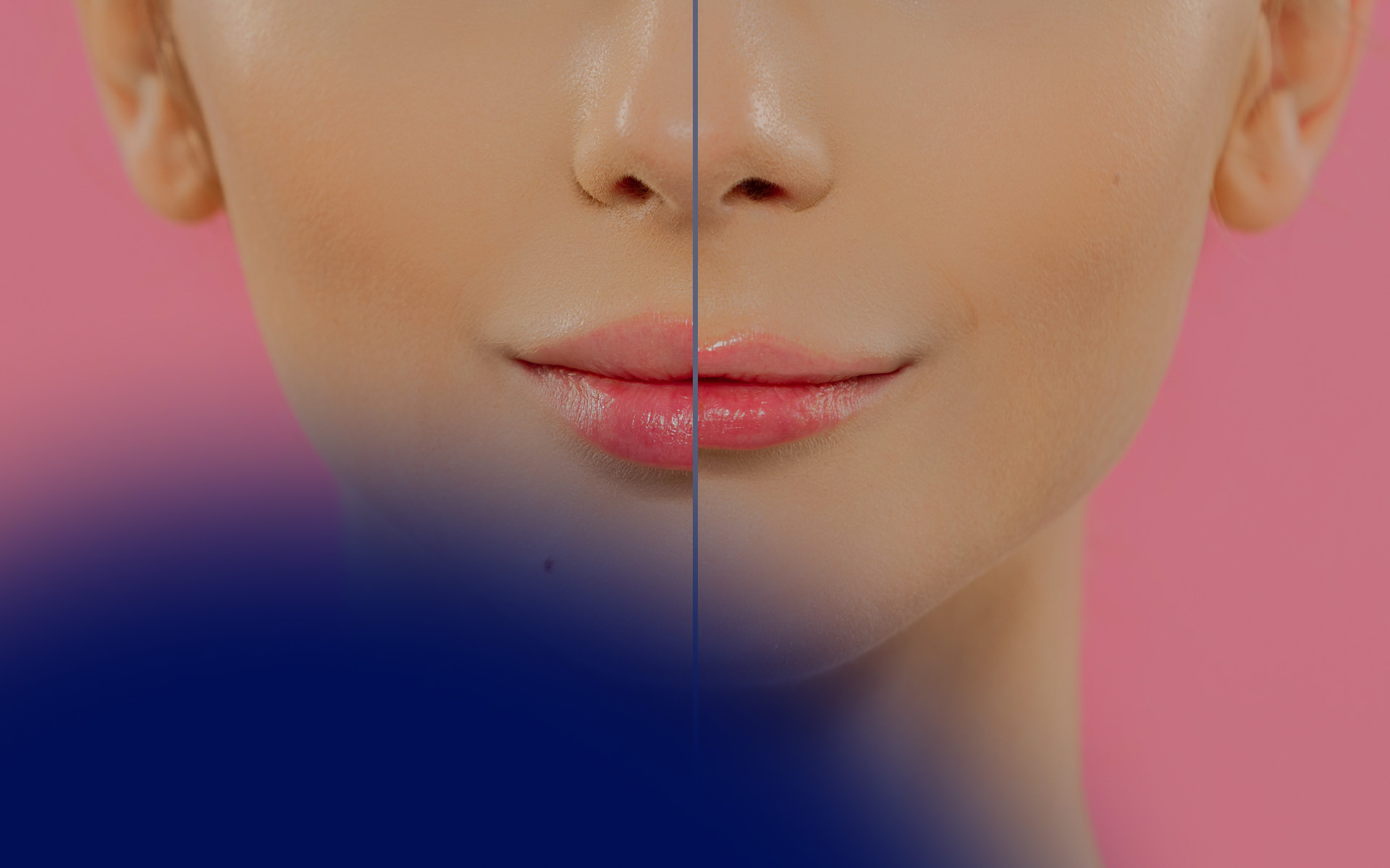 Juvéderm Before and After: Clinical Insights and Treatment Outcomes