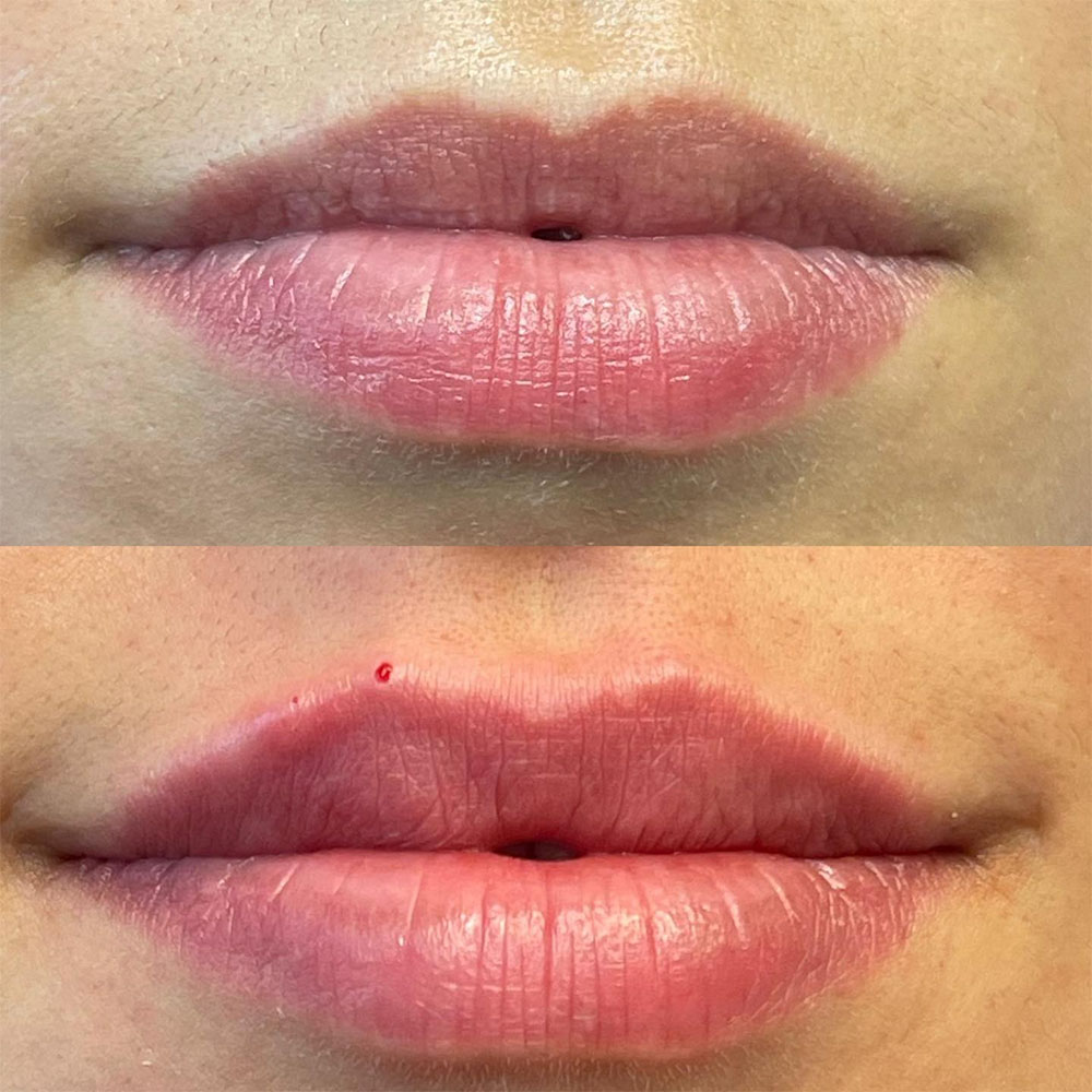 Juvéderm before and after