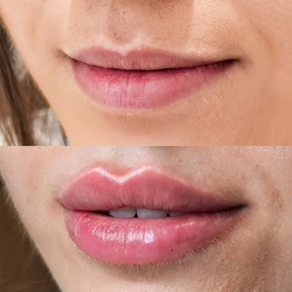 Juvéderm before and after