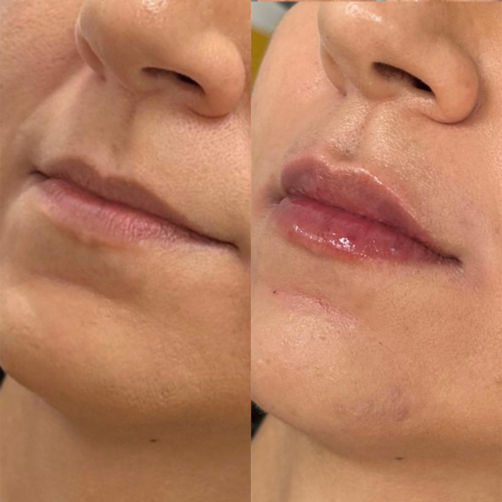 Juvéderm before and after