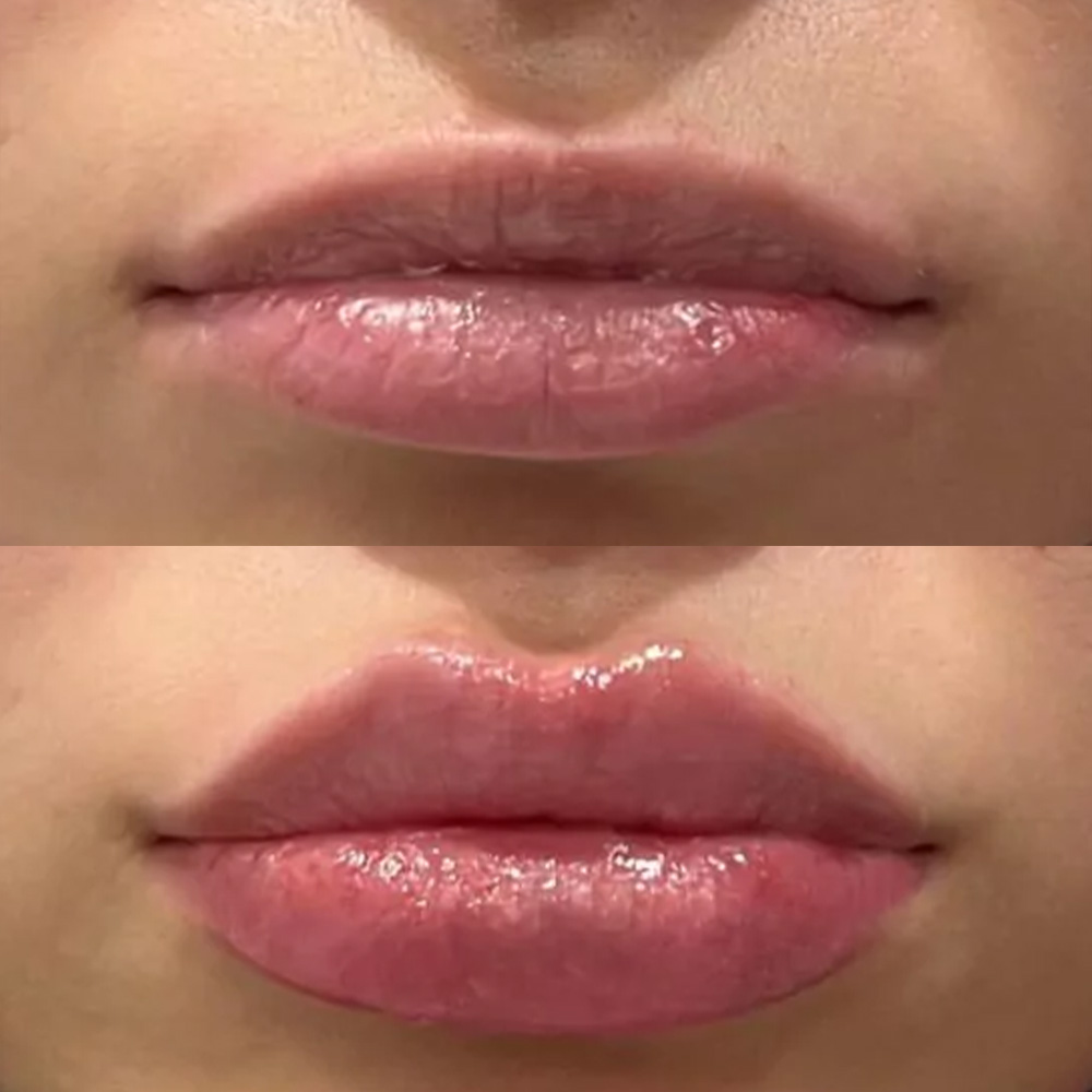 lip augmentation with Juvéderm