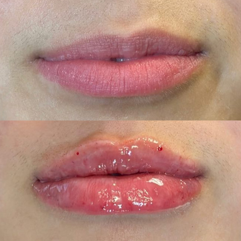 lip augmentation with Juvéderm