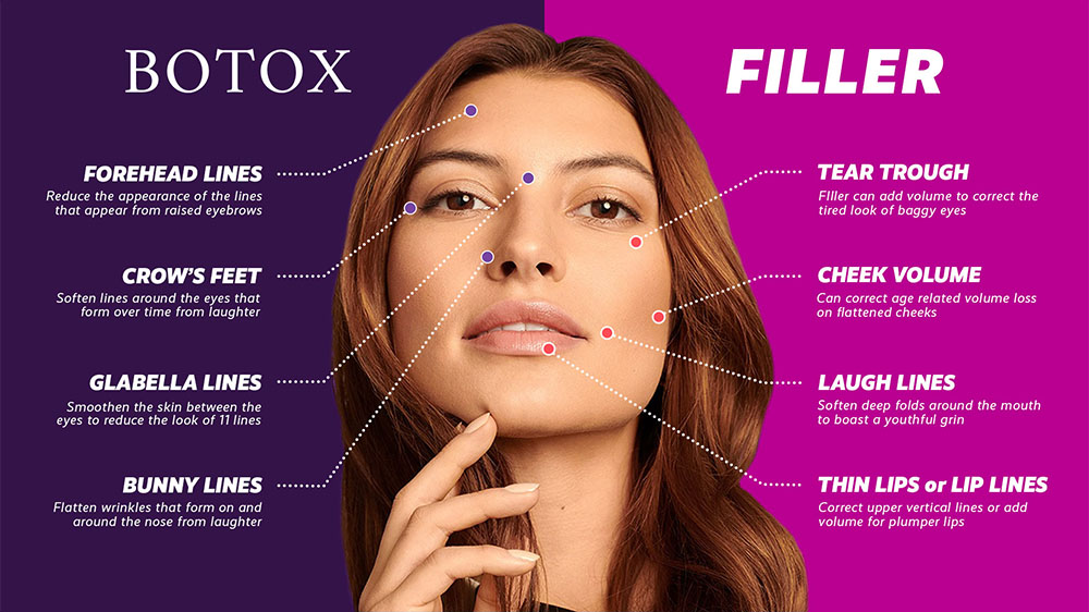 Juvéderm vs Botox