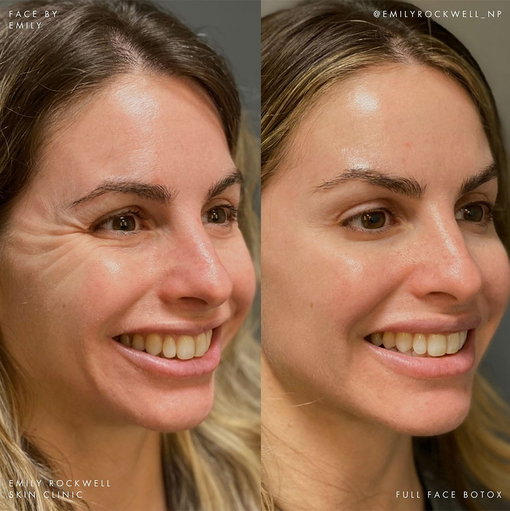 Juvéderm vs Botox