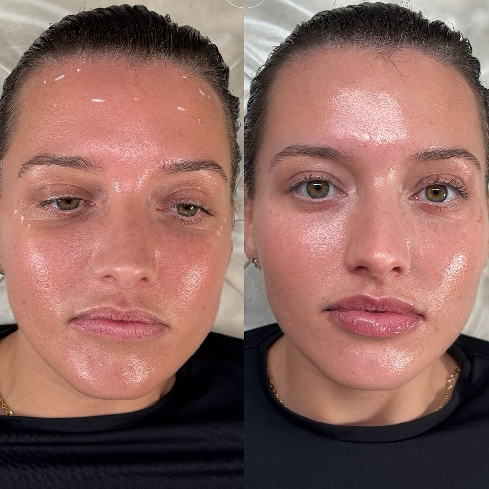 Juvéderm vs Botox