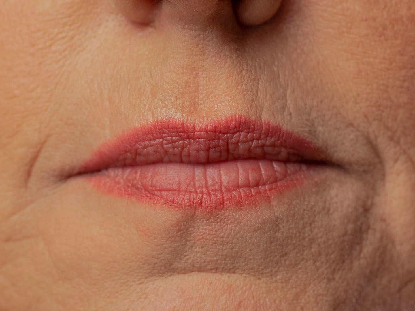 Juvéderm for Vertical Lip Lines: Before-and-After Insights and Injection Tips