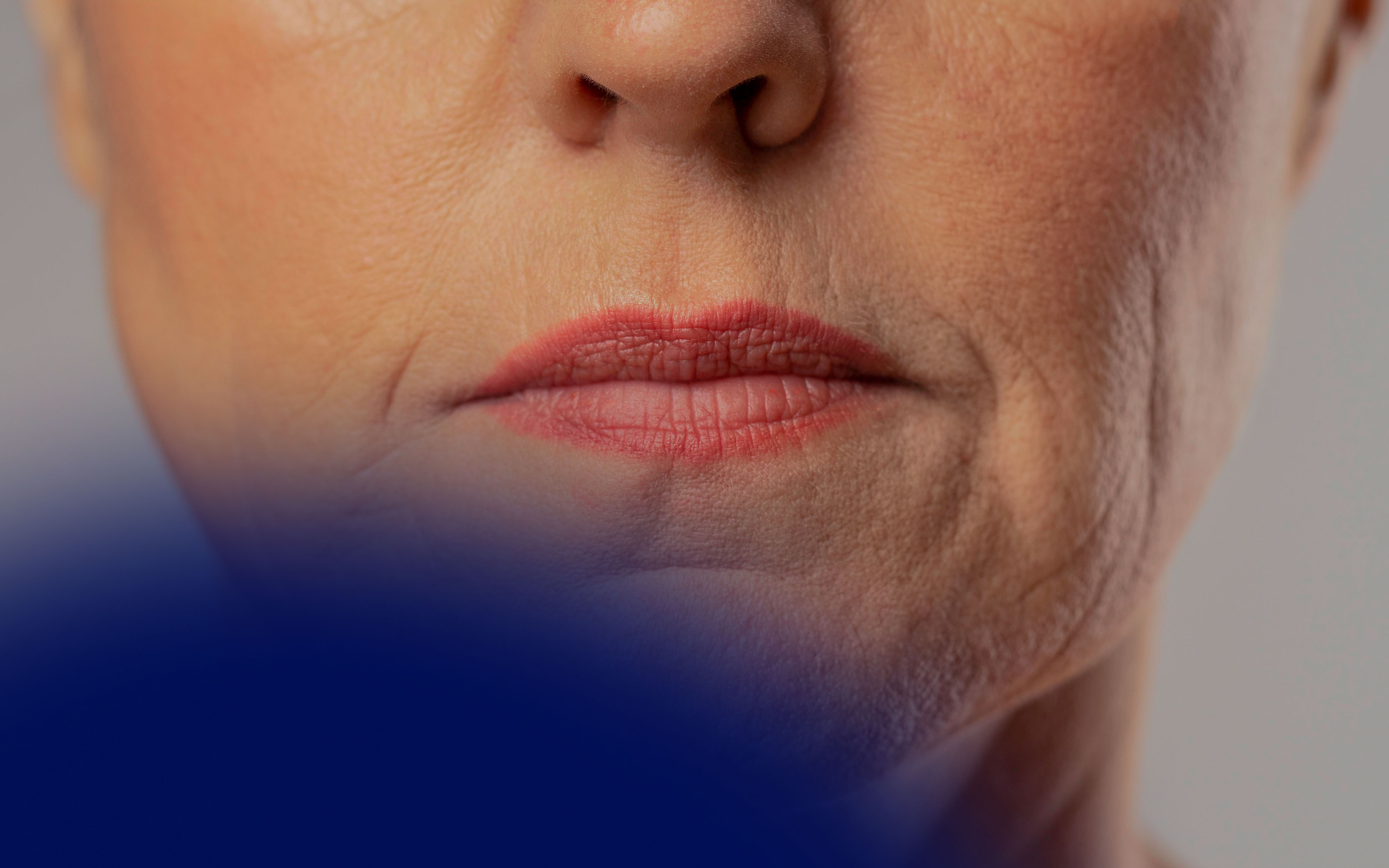 Juvéderm for Vertical Lip Lines: Before-and-After Insights and Injection Tips