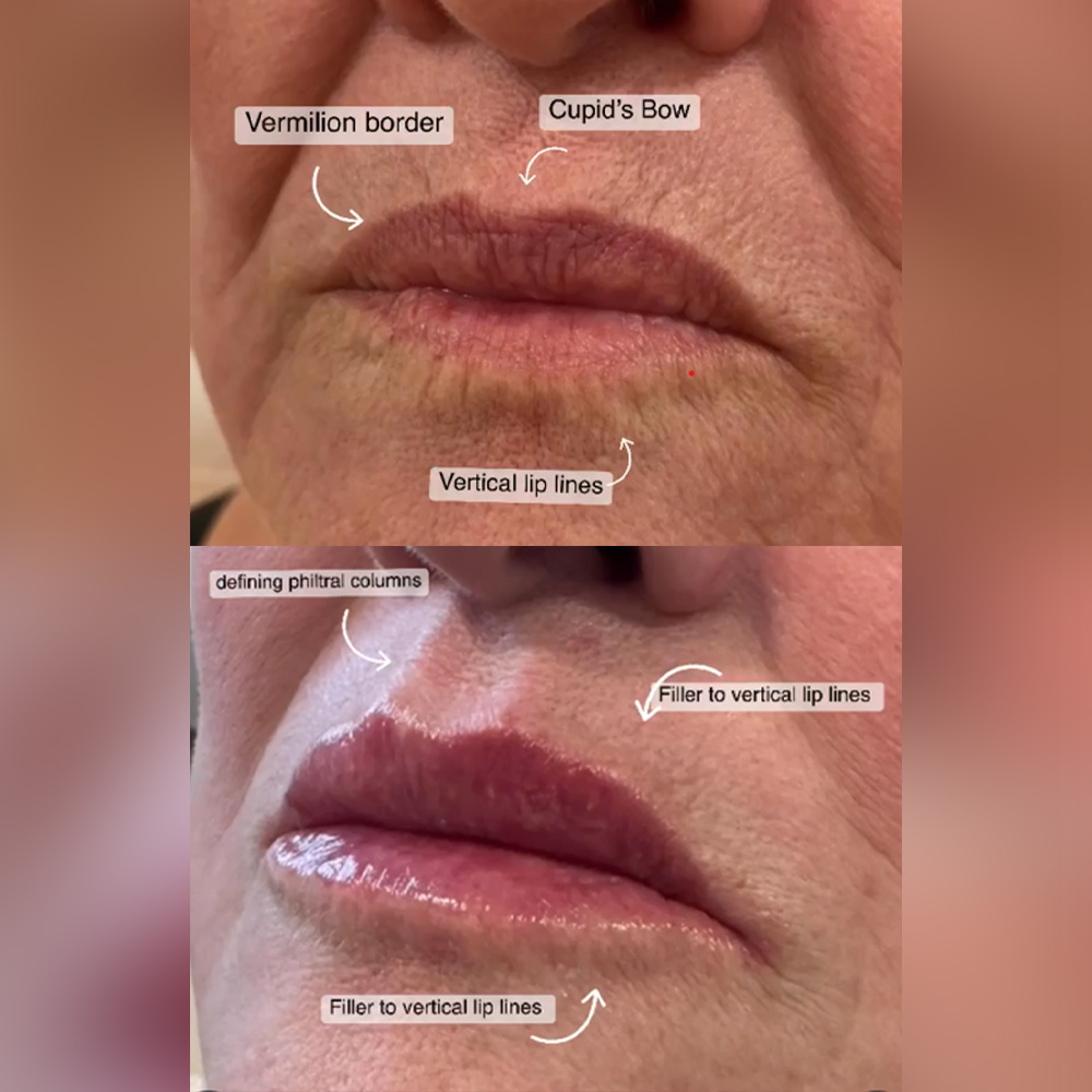 Juvéderm vertical lip lines before after