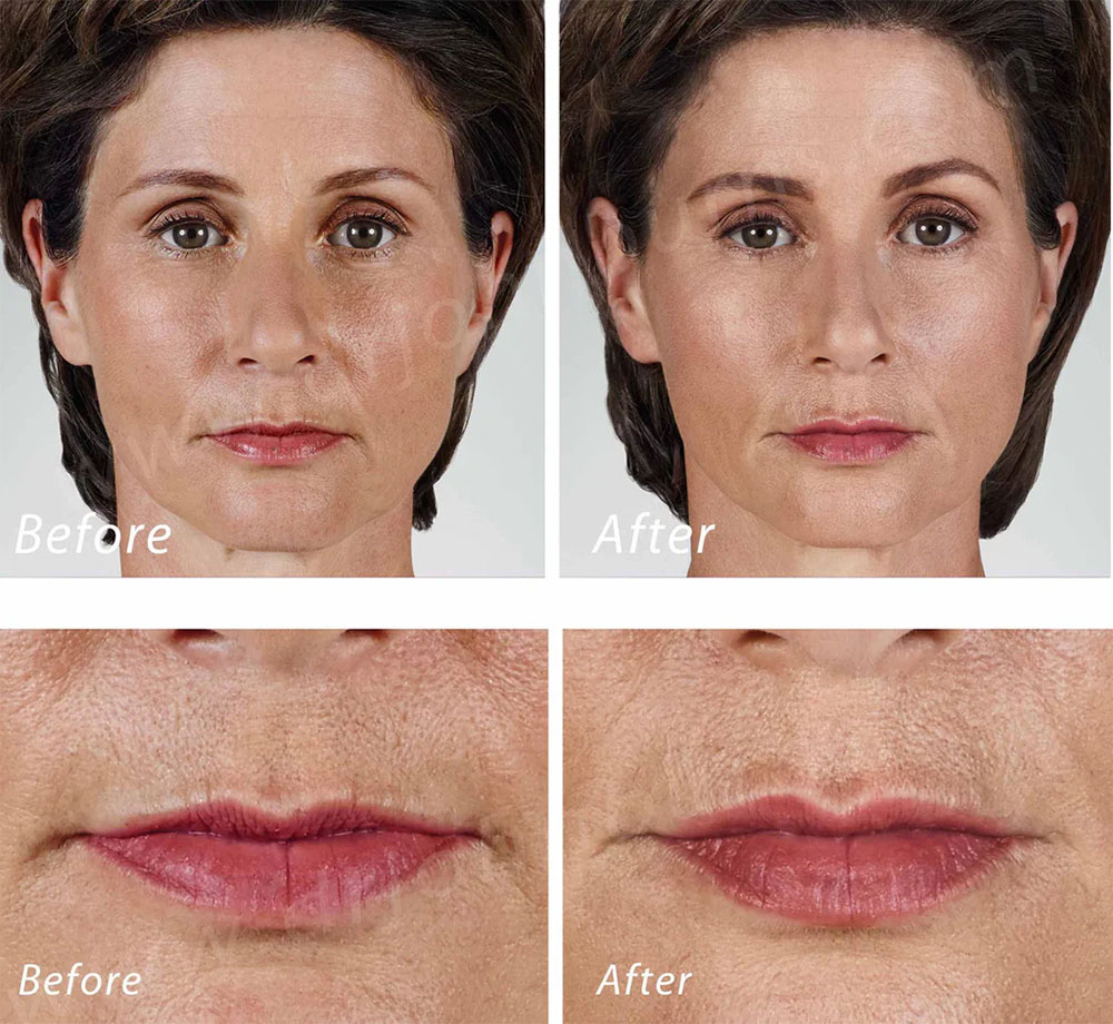 Juvéderm vertical lip lines before after