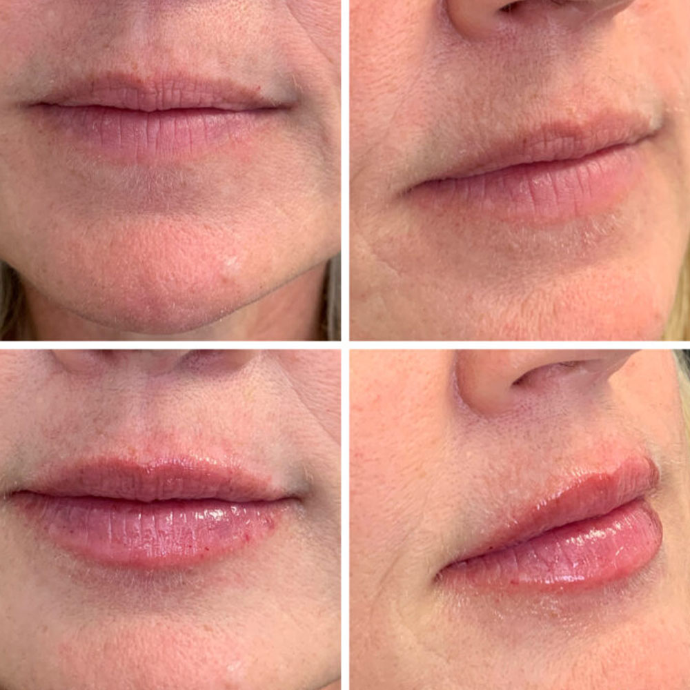 Juvéderm vertical lip lines before after