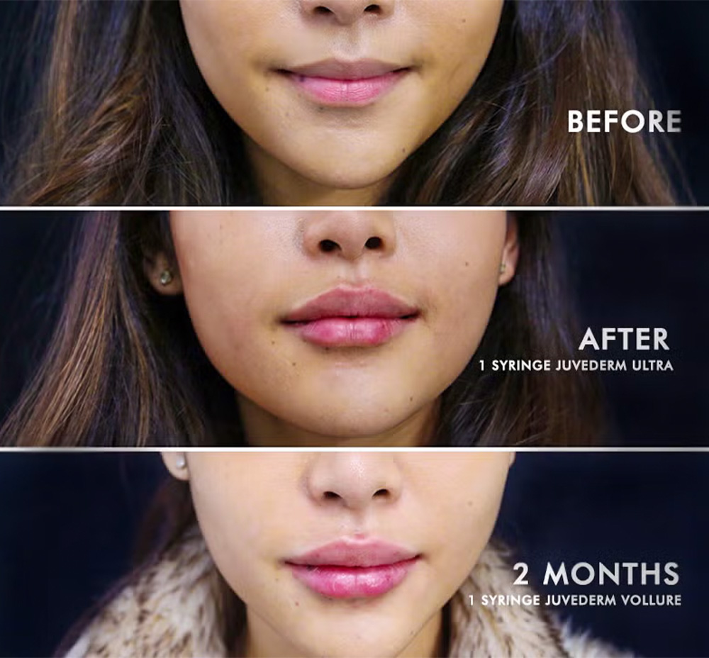 how long does Juvéderm last in lips