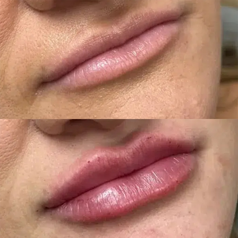 how long does Juvéderm last in lips