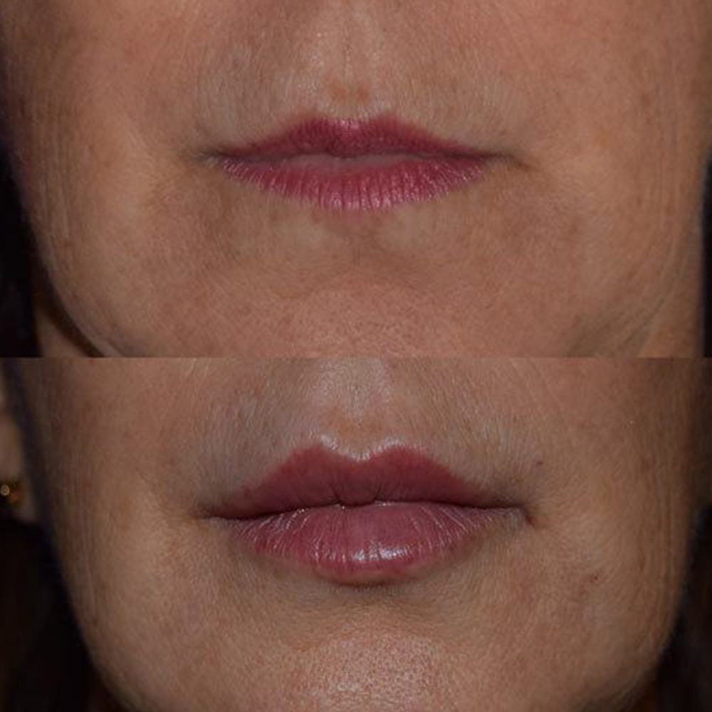how long does Juvéderm last in lips