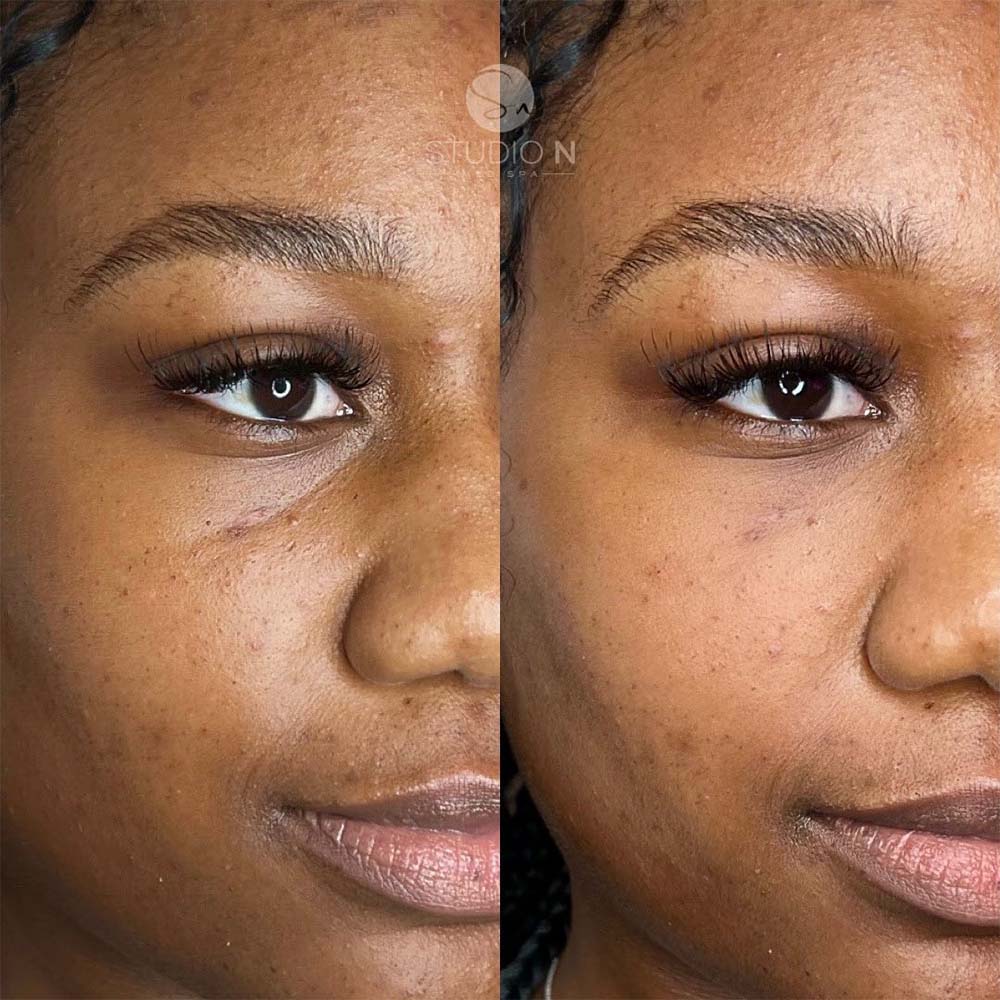 juvederm under eyes