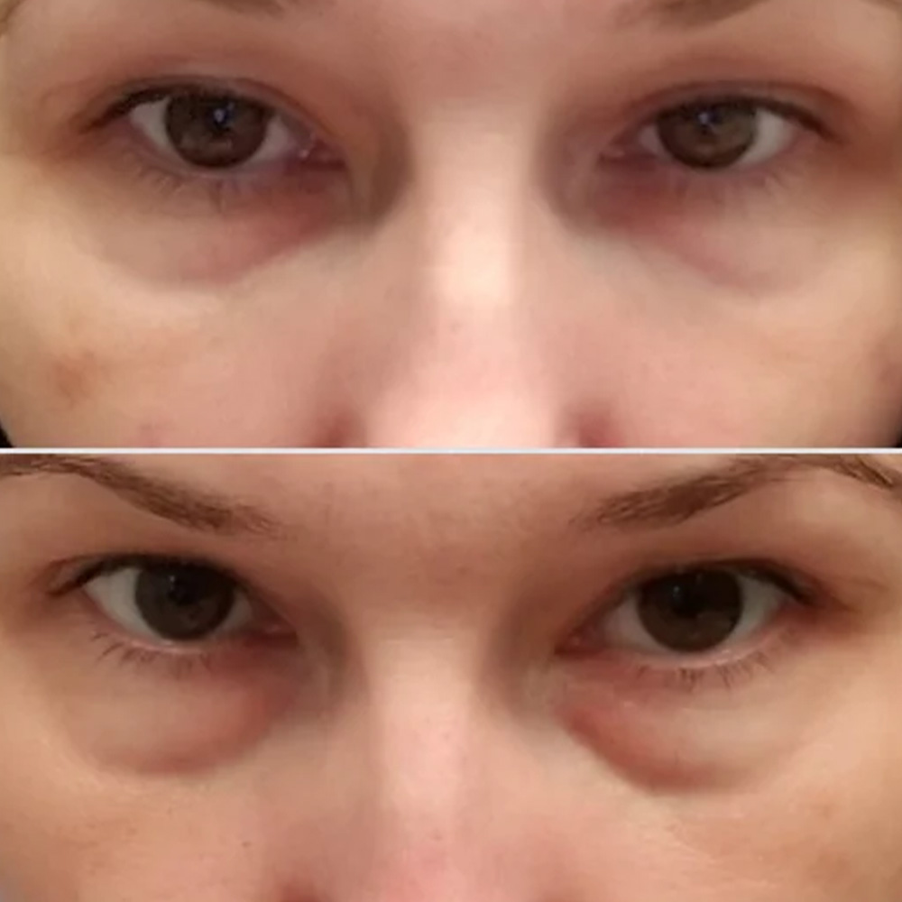 juvederm under eyes