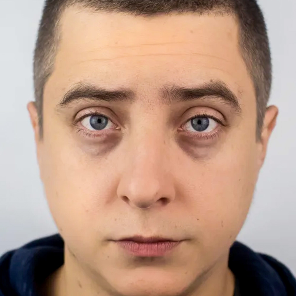 juvederm under eyes