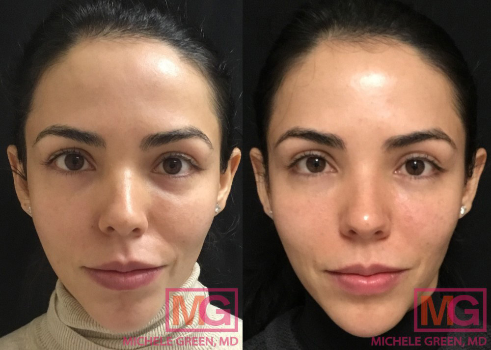 juvederm under eyes