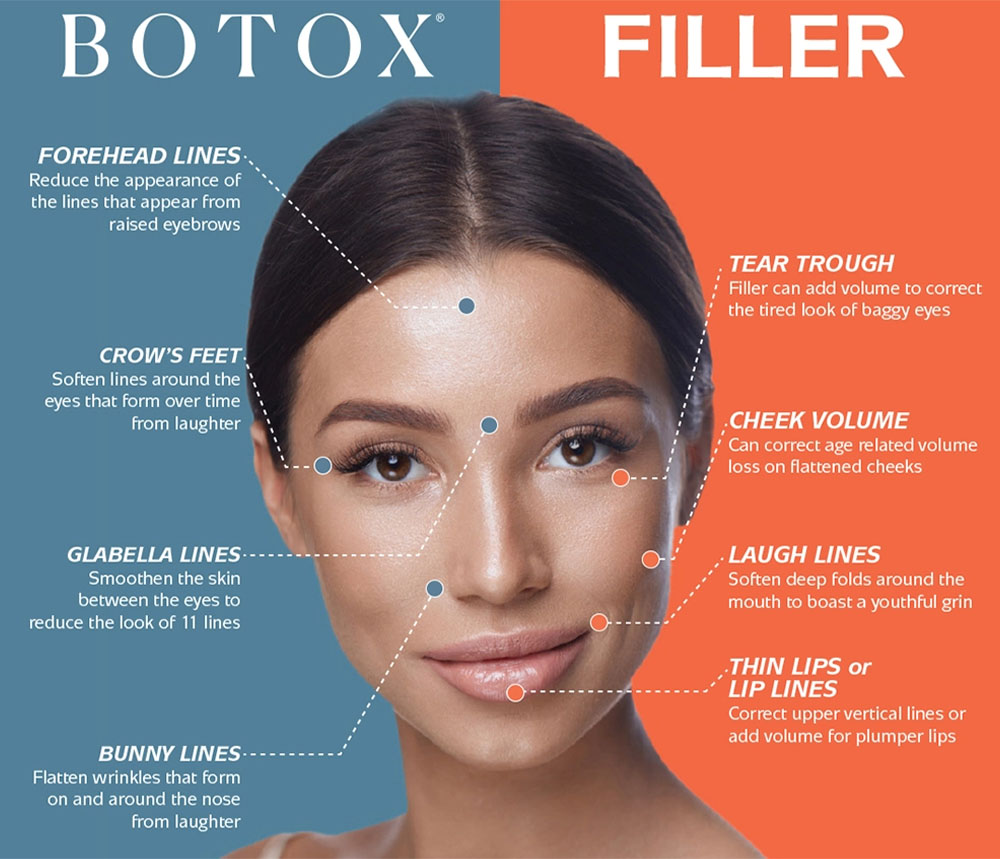 juvederm under eyes 