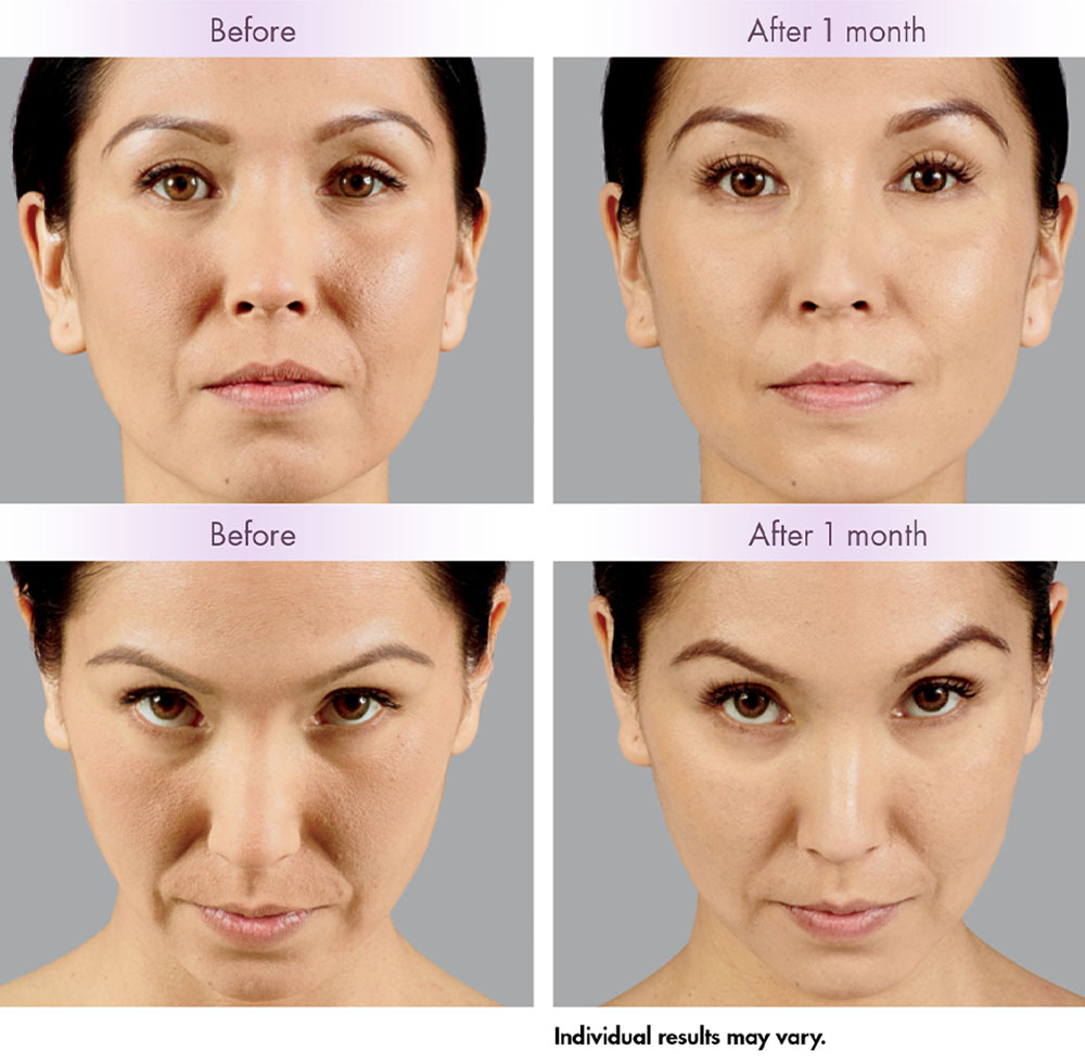 juvederm cheek filler