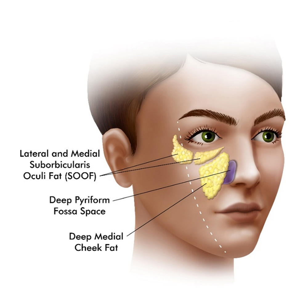 juvederm cheek filler