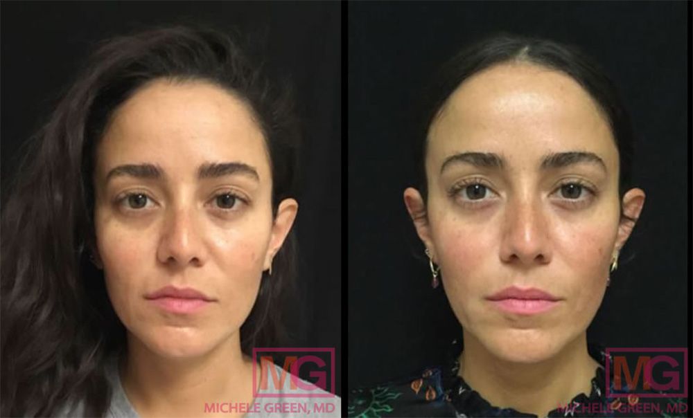 juvederm cheek filler