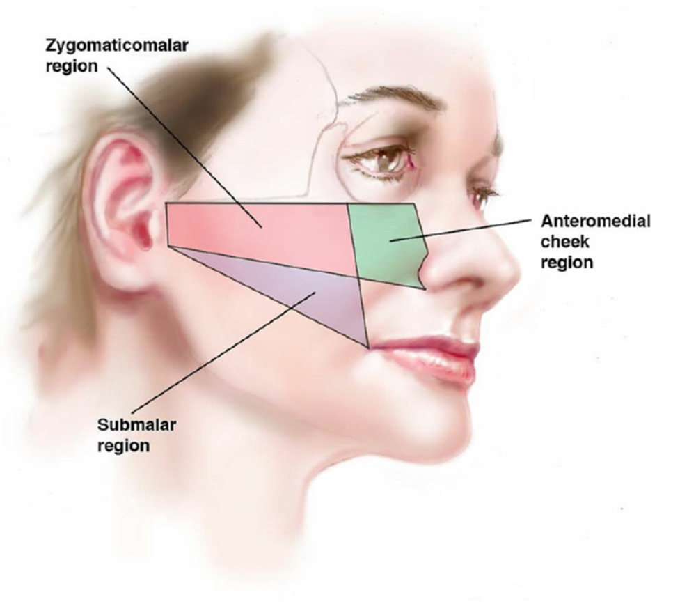 juvederm cheek filler