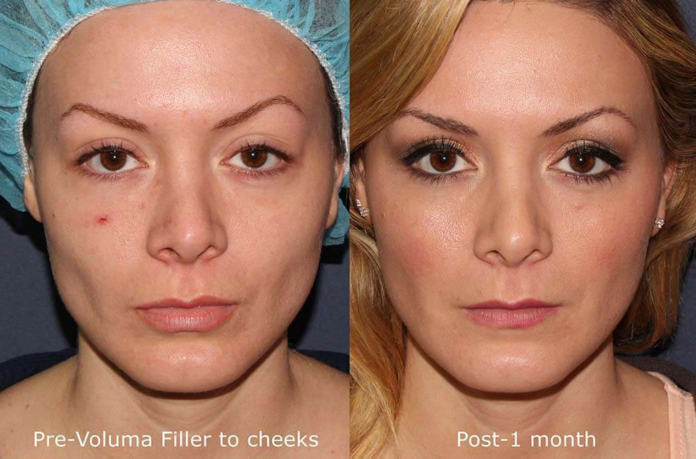 Juvederm cheek filler