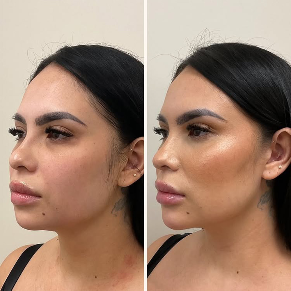 juvederm cheek filler