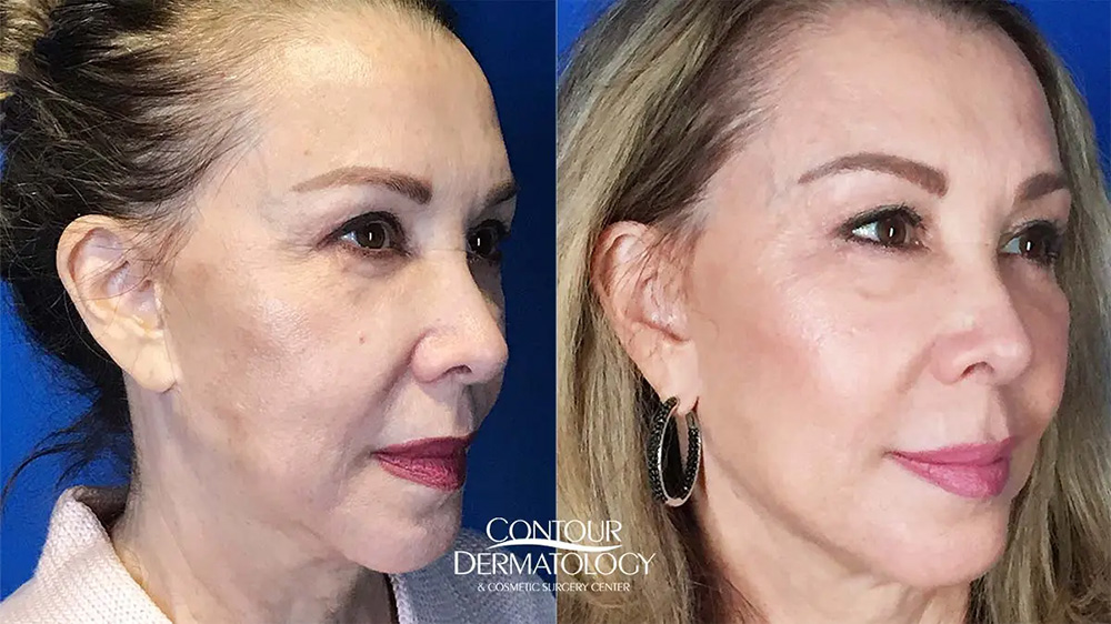 juvederm for jowls
