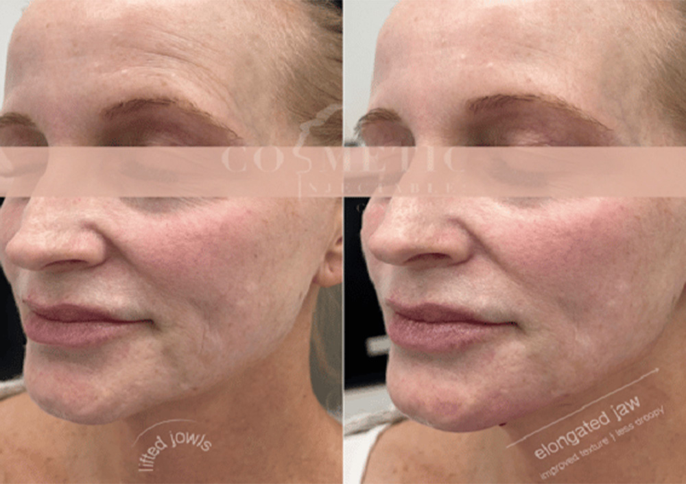 juvederm for jowls