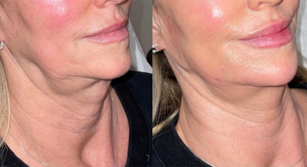 juvederm for jowls