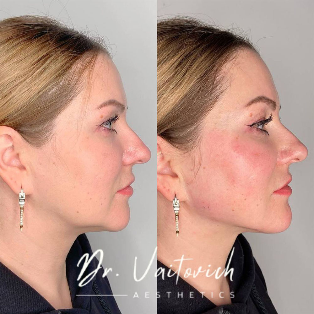 juvederm for jowls