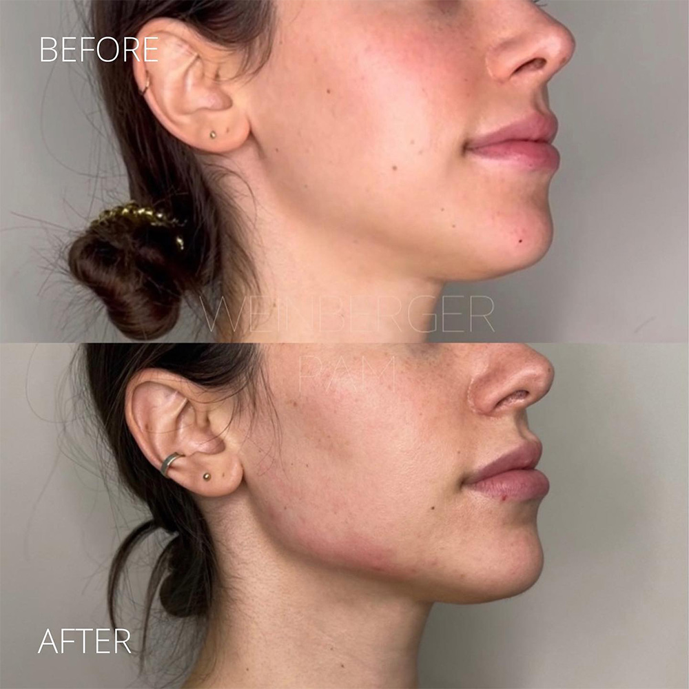 juvederm for jowls