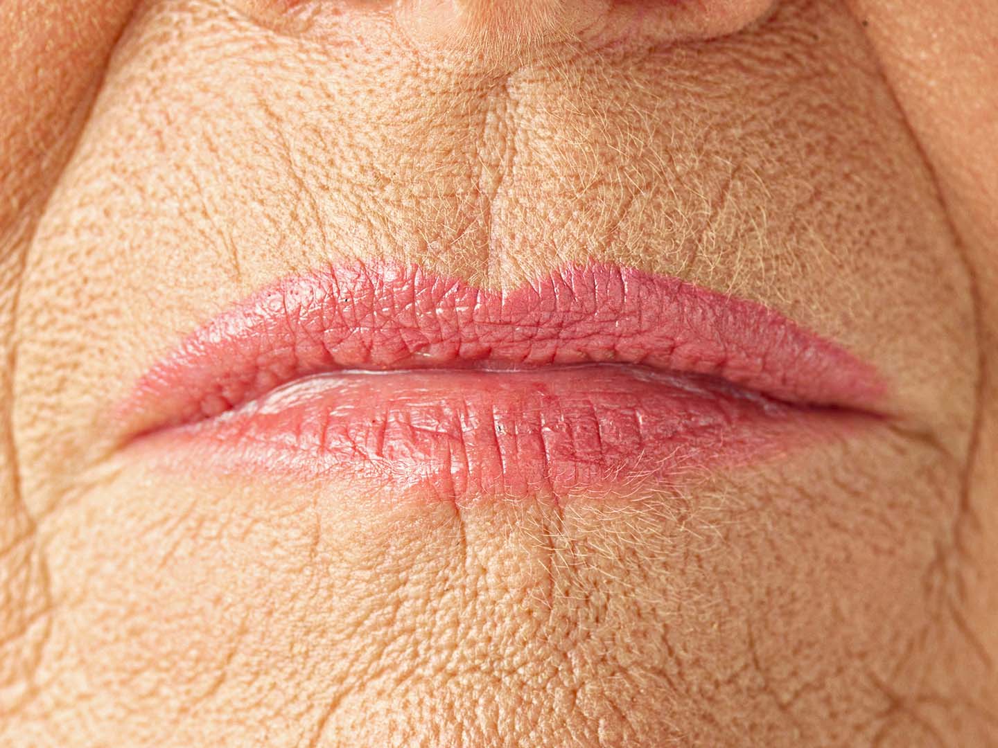 Treating Vertical Lip Lines: Filler Techniques for Natural Results