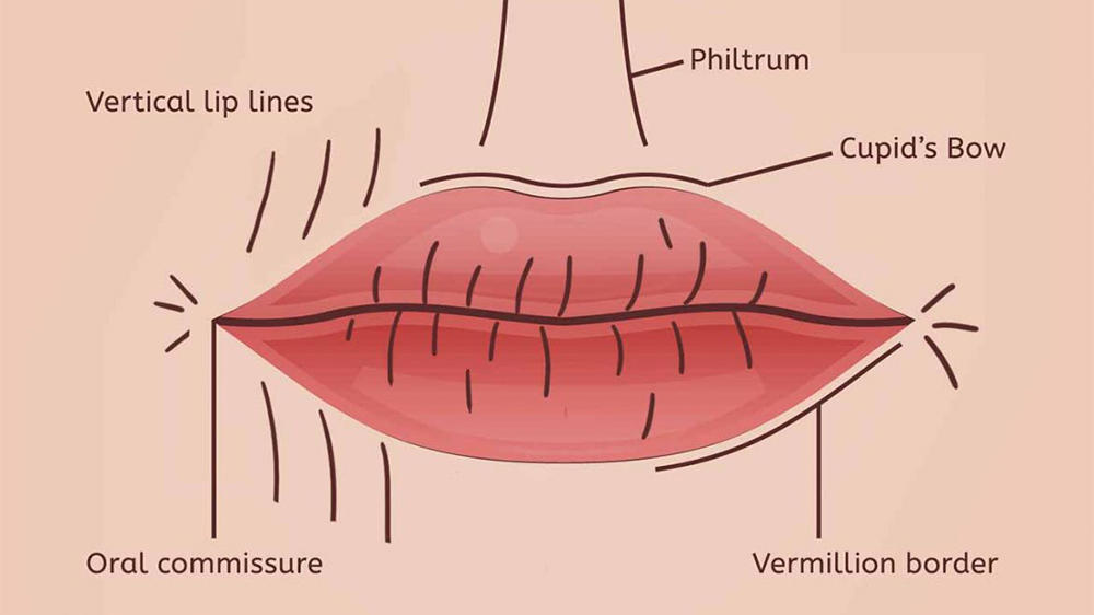 vertical lip lines filler