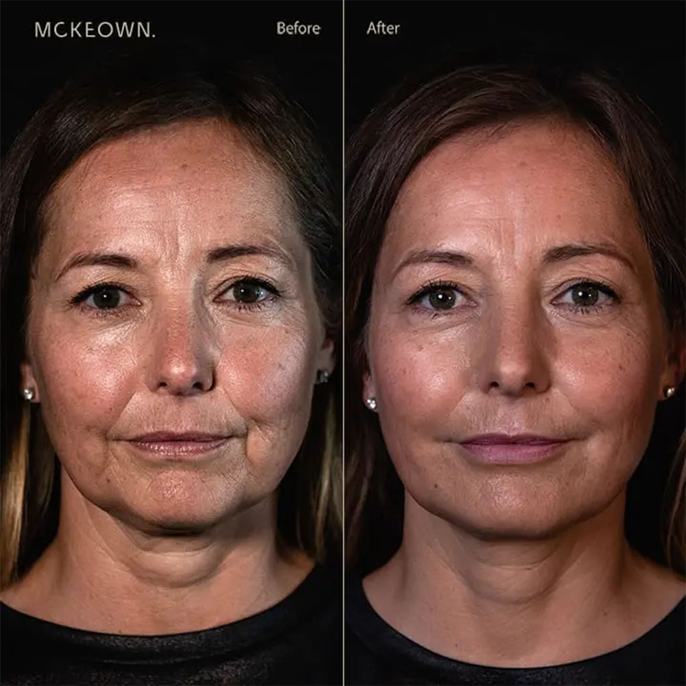 vertical lip lines filler