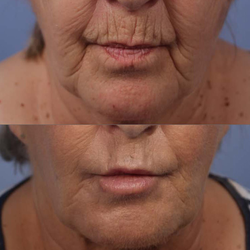 vertical lip lines filler