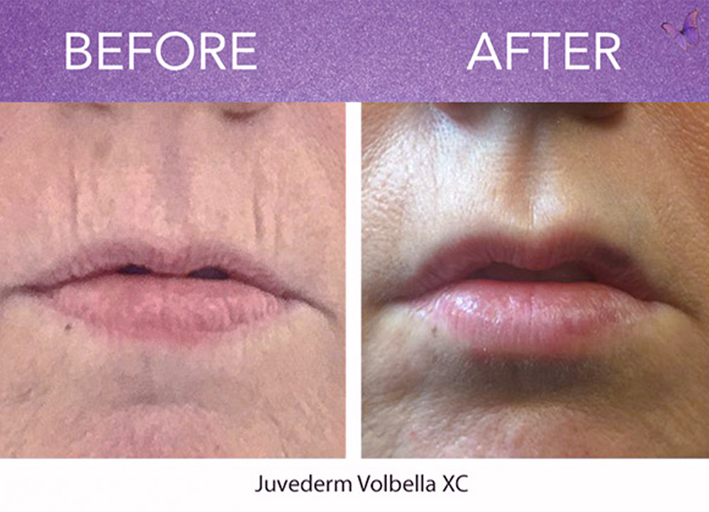 vertical lip lines filler