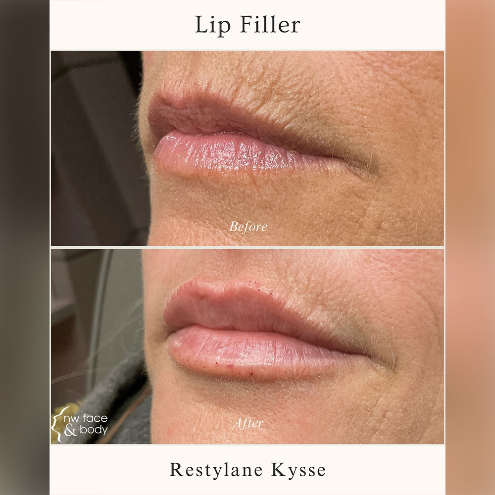 vertical lip lines filler