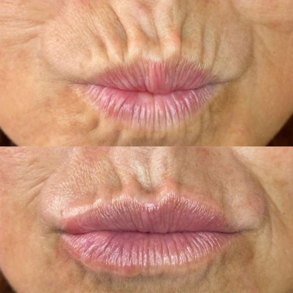 vertical lip lines filler