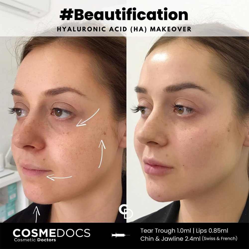 Liquid Face Lift procedure